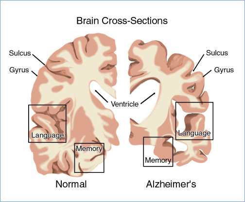 alzheimer-brain
