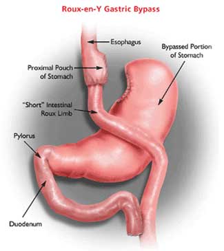 gastric_bypass_roux-en-y