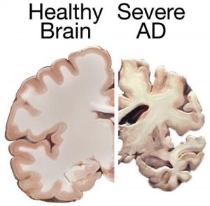 HERE’S YOUR BRAIN ON B12 DEFICIENCY- MEMORY LOSS AND AGING, WWW.B12PATCH.COM