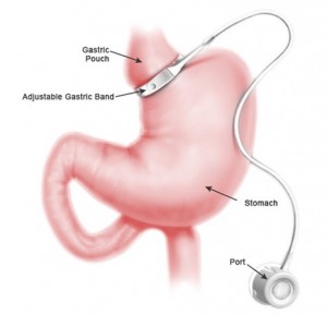 GASTRIC BYPASS SURGERY BETTER THAN BANDING, BUT MORE DANGEROUS, B12PATCH
