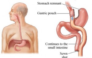 GASTRIC BYPASS SURGERY BETTER THAN BANDING, BUT MORE DANGEROUS, B12PATCH
