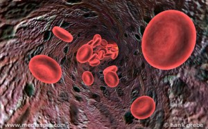 Pernicious anemia kills red blood cells Pernicious Anemia and Stomach Cancer Risks: What you need to Know